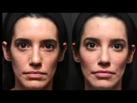 Facial Sculpting Liquid Facelift ‣ M.W.A Aesthetics